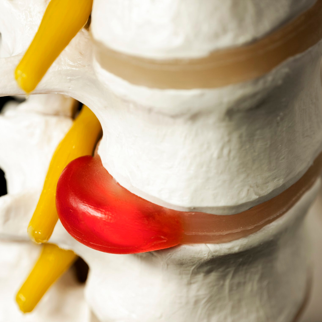 Chiropractic Care For Bulging Disc In Fort Collins CO