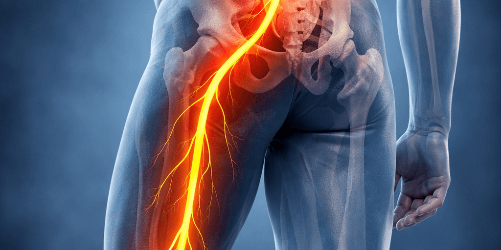 lumbar spine showing path of sciatic nerve