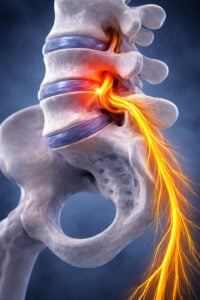 Sciatica-red-flags-cauda-equina